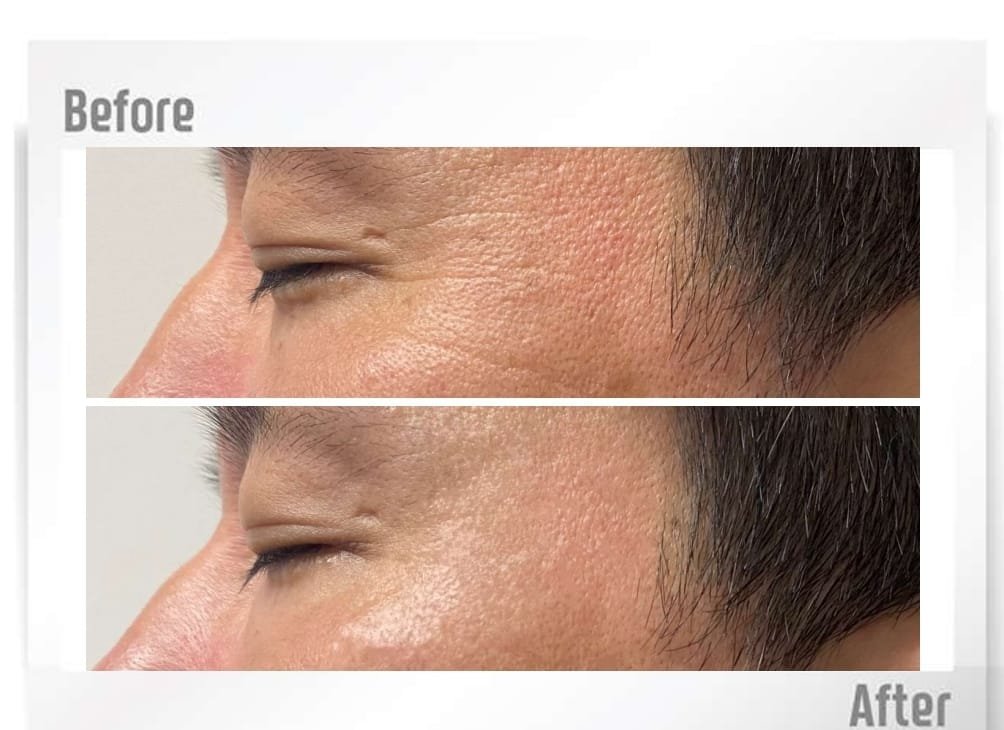 haPN 70 fine lines before and after