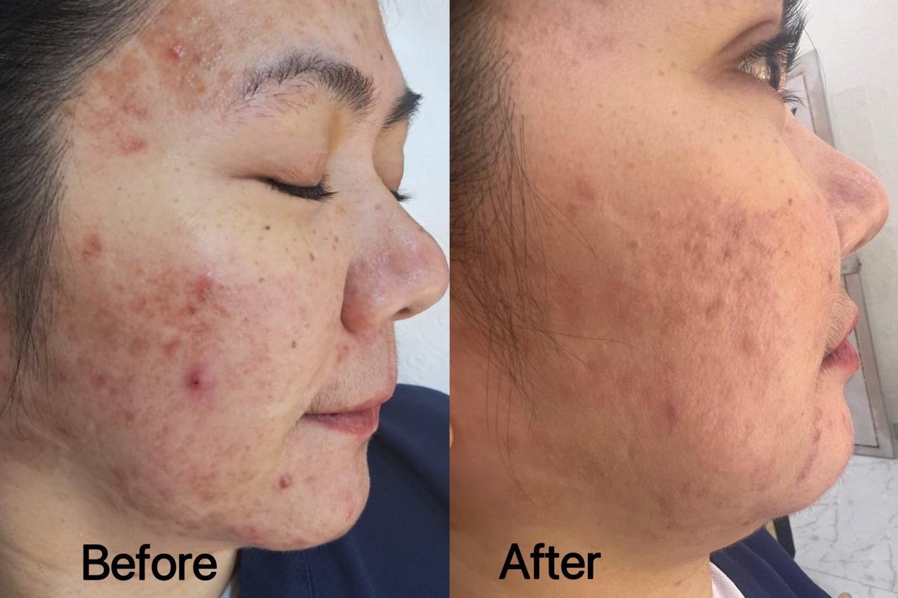 LIXOFORD-S acne and skin clarity before and after