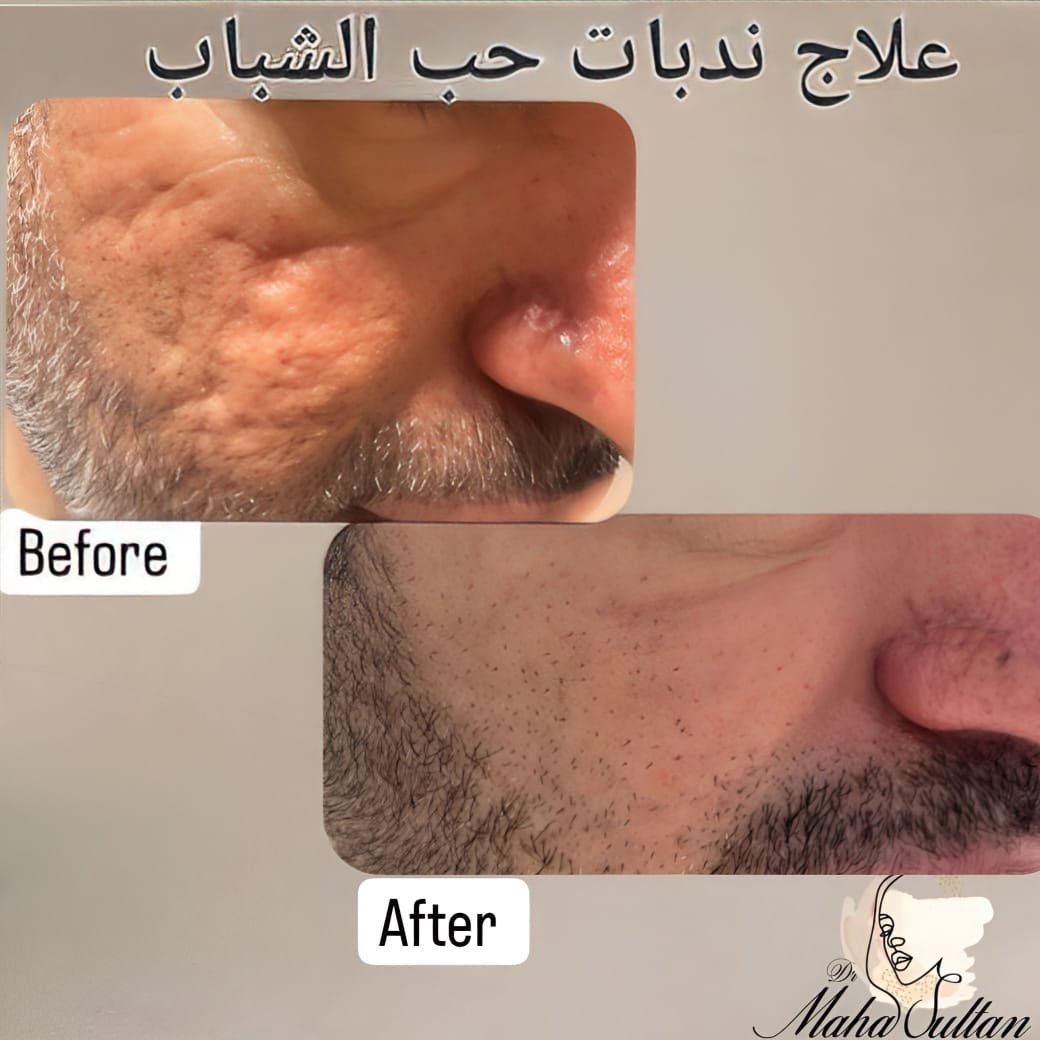 LIXOFORD-S acne scarring before and after