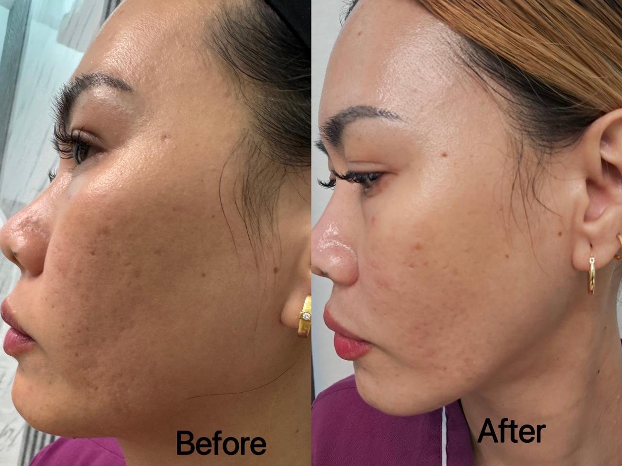 LIXOFORD-S skin tone and texture before and after
